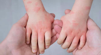 How can children and adults effectively manage symptoms and find relief in facing the global challenge of dermatitis?