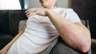 Understanding Plaque Psoriasis: Symptoms and Treatment Options